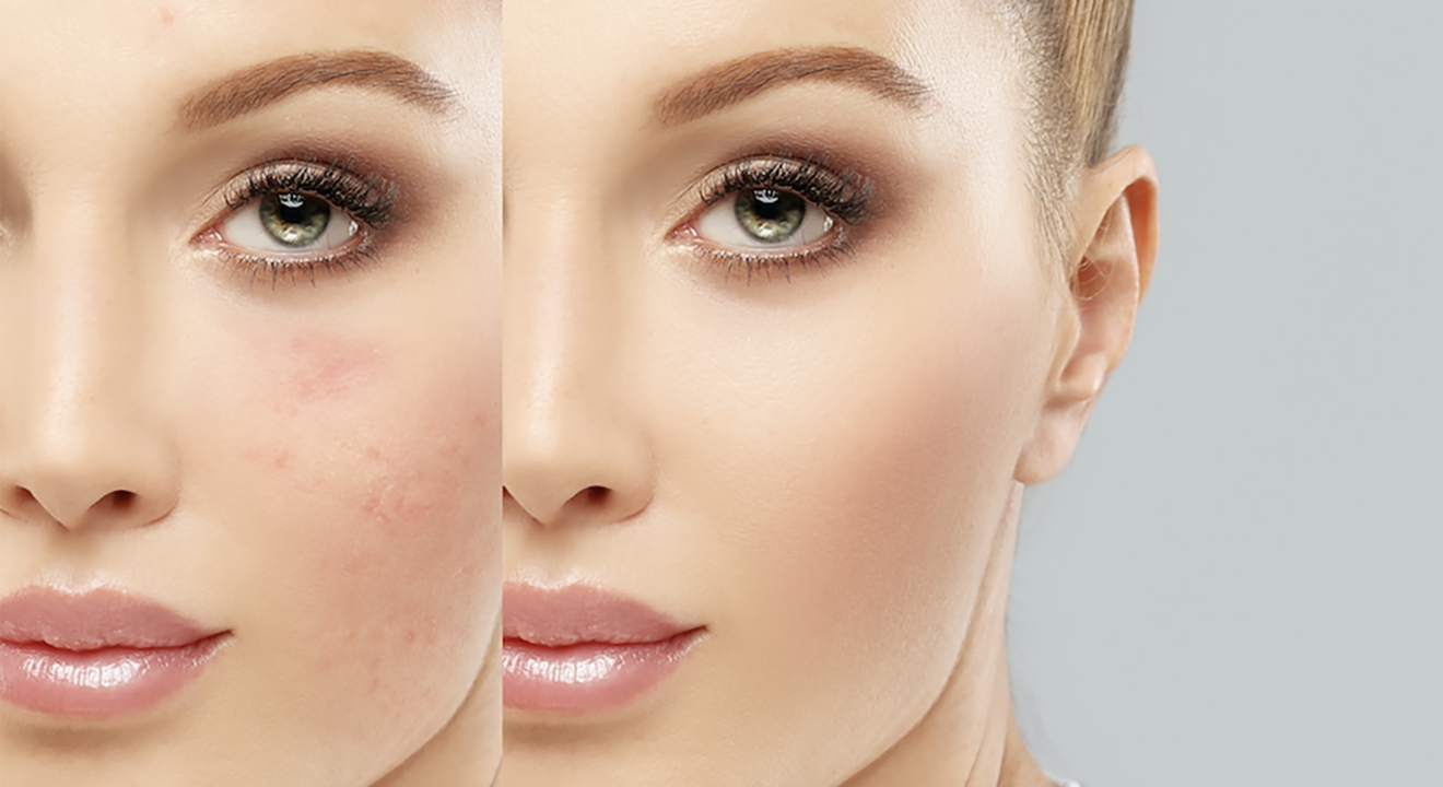 Entity talks acne scar lighteners
