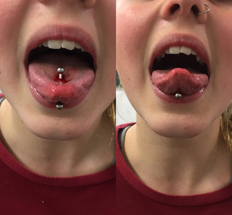 ENTITY reports on tongue piercings